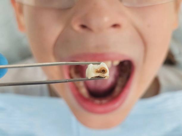 Best Emergency Tooth Extraction in Stanley, ND